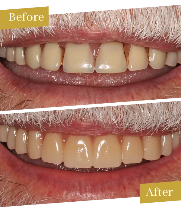 Before and After Dentures