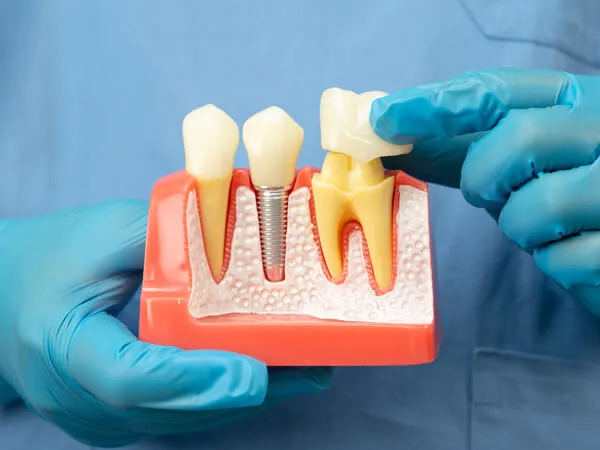 Dental Crown at Toftwood Dental