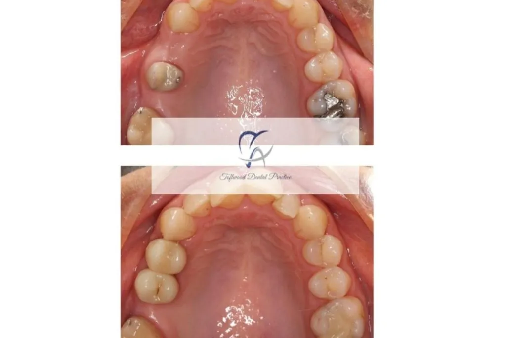 Before and after dental implant, open mouth close up