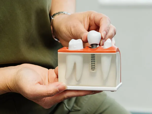 Dental Implants at Toftwood Dental