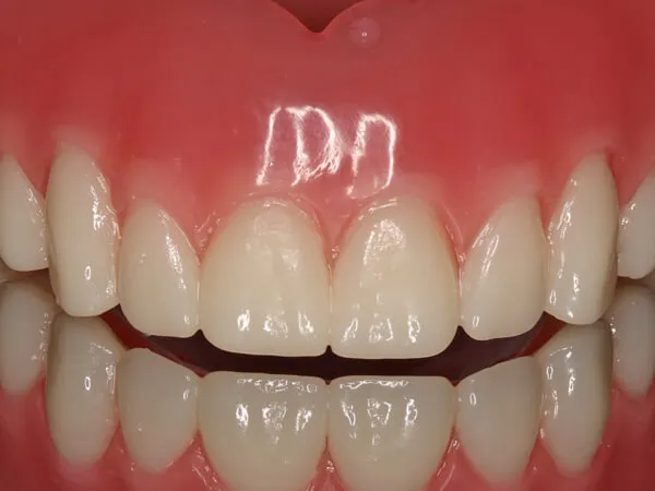 Dentures