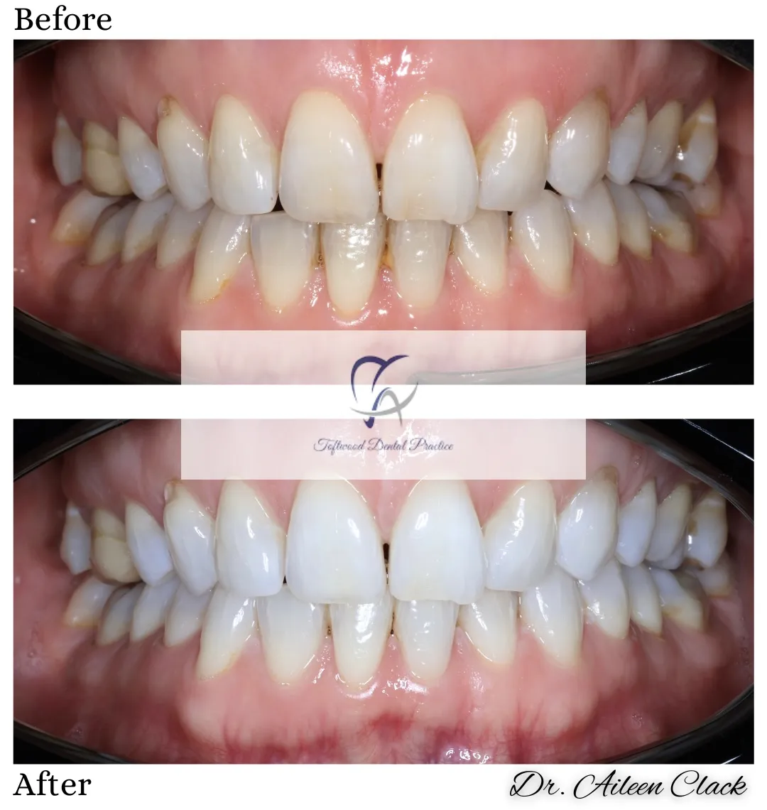 Before and After Teeth Whiting with Toftwood Dental